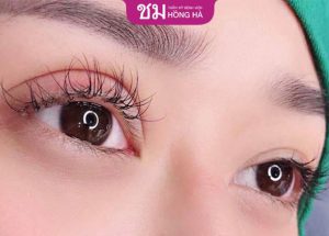 Những vấn đề thường gặp sau khi cắt mí – Cách khắc phục