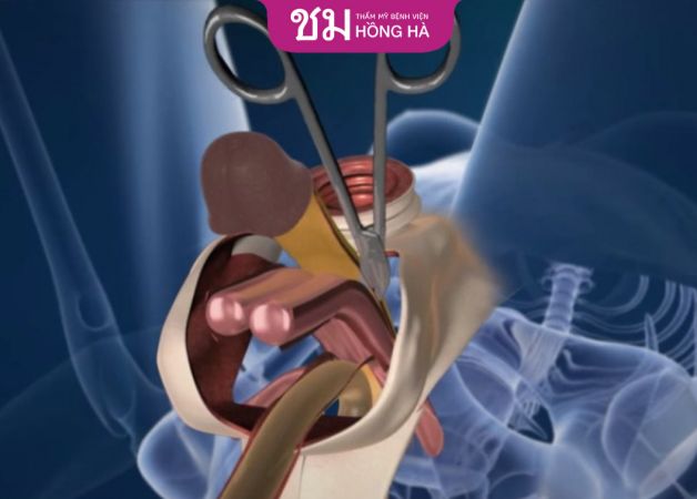 Quá trình thực hiện chuyển đổi giới tính từ nam sang nữ
