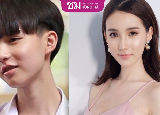 Khách hàng cần chuẩn bị tâm lý thoải mái trước khi thực hiện phẫu thuật để đạt kết quả tối ưu