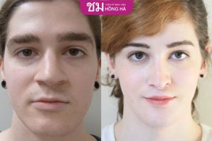 Phẫu thuật nữ hóa khuôn mặt là gì? Cần thực hiện những gì?