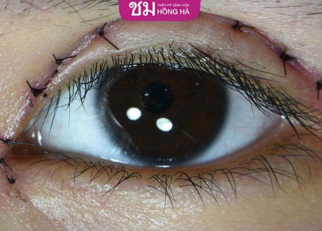 Cắt mí mắt 2 tháng vẫn bị thâm