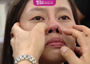 Chỉnh sửa mũi hỏng – Giải quyết biến chứng sau nâng mũi