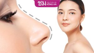 Sụn nâng mũi Surgiform – Mũi đẹp, hoàn hảo chuẩn Hot girl