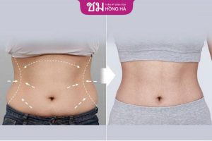 Tạo hình bụng: Áp dụng cho đối tượng nào? Quy trình phẫu thuật