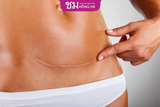 Tạo hình thành bụng có nguy hiểm không là vấn đề nhiều người lo lắng