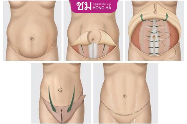Mô phỏng kỹ thuật tạo hình bụng toàn phần (tiêu chuẩn)