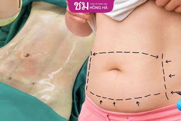 Phẫu thuật tạo hình bụng là gì?