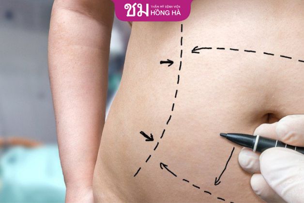 Tạo hình thành bụng ở đâu tốt? Tạo hình thành bụng ở đâu đẹp cần được cân nhắc lựa chọn kỹ lưỡng