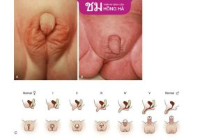 Tình trạng lưỡng giới giả nữ và thông tin cần nắm rõ