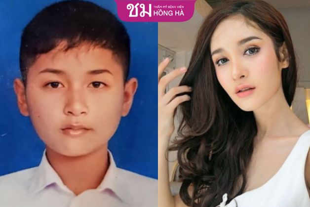 Quá trình chuyển đổi giới tính của một người transgirl