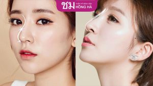 Bảng giá mới nâng mũi S line tại Thẩm mỹ Hồng Hà