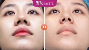Cắt cánh mũi giá bao nhiêu tại Thẩm mỹ Hồng Hà