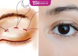Cắt chỉ sau khi cắt mí có đau không? Chăm sóc kết quả tối ưu
