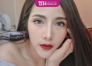 Cắt mí mắt sau 2 tháng vẫn sưng:Nguyên nhân & giải pháp khắc phục