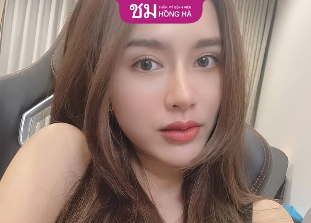 Cắt mí mắt sau 2 tháng, mí hết sưng đau