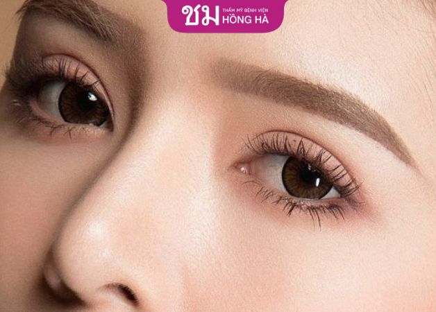 Sau cắt mí hỏng từ 1 - 3 tháng có thể cắt mí lại