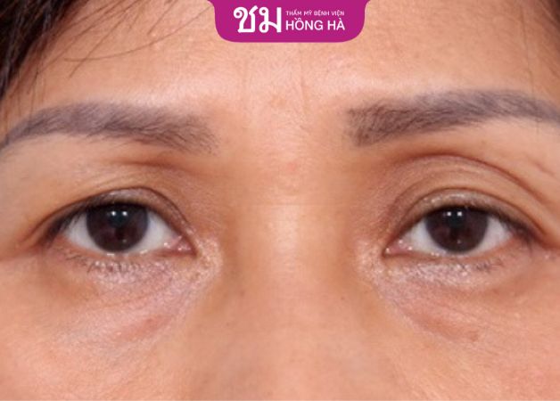 Trường hợp cắt mí sâu bị lõm nên cắt mí lại