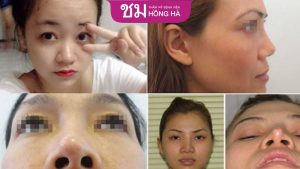4 Dấu hiệu nhận biết mũi tụt sụn sau nâng mũi – Cách khắc phục