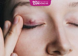 Bảo vệ mắt: 3 dấu hiệu nhiễm trùng nhấn mí – Thống kê mới