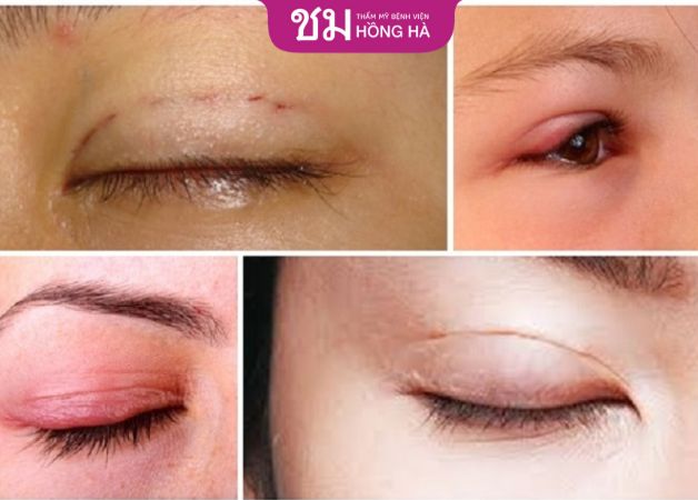 Tình trạng bầm tím và sưng nề sau nhấn mí là phản ứng tự nhiên của cơ thể