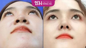 Giá thu nhỏ đầu mũi: Bảng giá và những lưu ý trước khi phẫu thuật