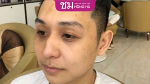 Khắc phục mũi gãy hiệu quả chỉ 90 phút tại Thẩm mỹ Hồng Hà