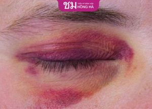 Nguyên nhân Nâng cung chân mày bị bầm tím