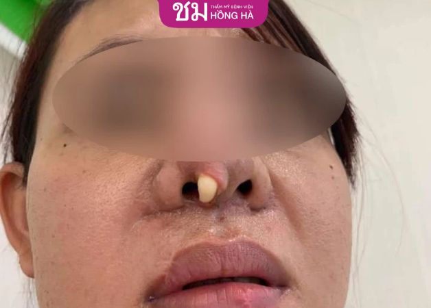 Nguyên nhân gây lòi sụn sau khi nâng mũi