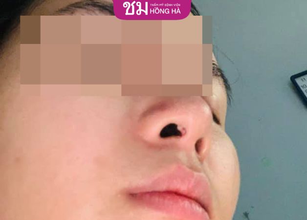 Lòi sụn trong lỗ mũi có gây nguy hiểm đến sức khỏe