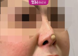 Nâng mũi bị lòi sụn trong lỗ mũi: Nguyên nhân và cách xử lý