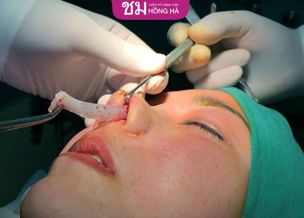 Khắc phục lòi sụn mức độ nặng bằng cách tái tạo lại dáng mũi
