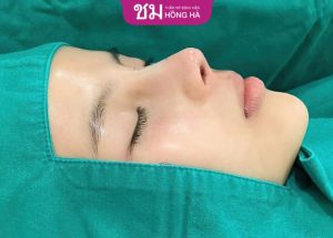 Hỏi đáp: Nâng mũi cấu trúc có sửa lại được không?