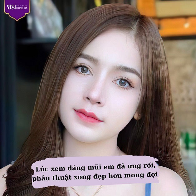 Nâng mũi cấu trúc Thai Shape tại Thẩm mỹ Bệnh viện Hồng Hà