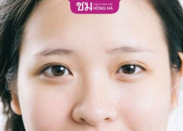 Nhấn mí hỏng có sửa được không - trường hợp 2 mí không đều nhau có thể sửa được