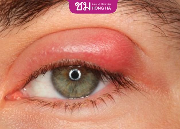 Sửa mí mắt sưng đỏ kéo dài