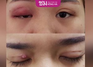 Nhấn mí hỏng có sửa lại được không 98% từ chuyên gia