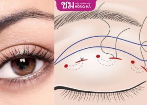 Nhấn mí sau bao lâu thì tiêu chỉ? Những yếu tố ảnh hưởng