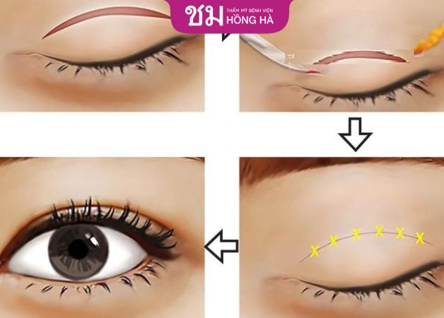 Nhấn mí sau bao lâu thì tiêu chỉ - Chỉ tự tiêu sau 15 - 60 ngày