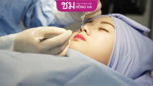 Sửa mũi có đau không – Tips giảm sưng, đau hiệu quả