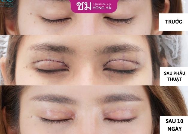 Hình ảnh thay đổi sau 10 ngày cắt mí