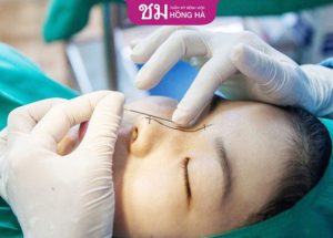 Top bác sĩ nâng mũi đẹp ở tphcm – Review thực tế