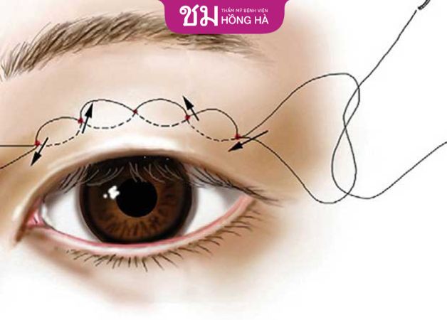 Sau tháo chỉ nhấn mí không để lại sẹo