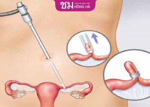 Cắt buồng trứng: Phương pháp và ảnh hưởng sau phẫu thuật