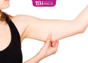 Hút mỡ bắp tay: Bí kíp vàng sở hữu bắp tay thon gọn nhanh chóng