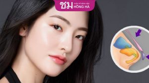 Nâng mũi bọc sụn giá bao nhiêu – Bảng giá cập nhập mới