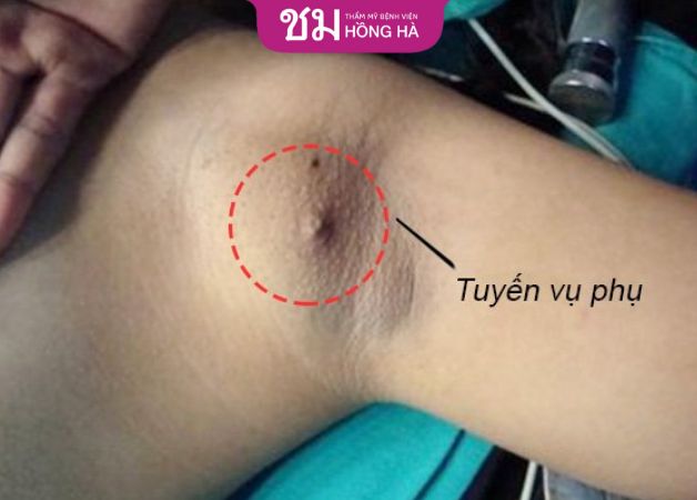 Không cắt bỏ tuyến vú phụ ở nách gây ra nhiều tác hại