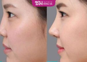 Mewing phương pháp cải thiện thẩm mỹ gương mặt hiệu quả