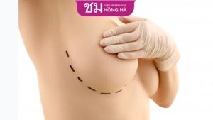 Cắt ngực giá bao nhiêu – 4 Yếu tố ảnh hưởng tới chi phí