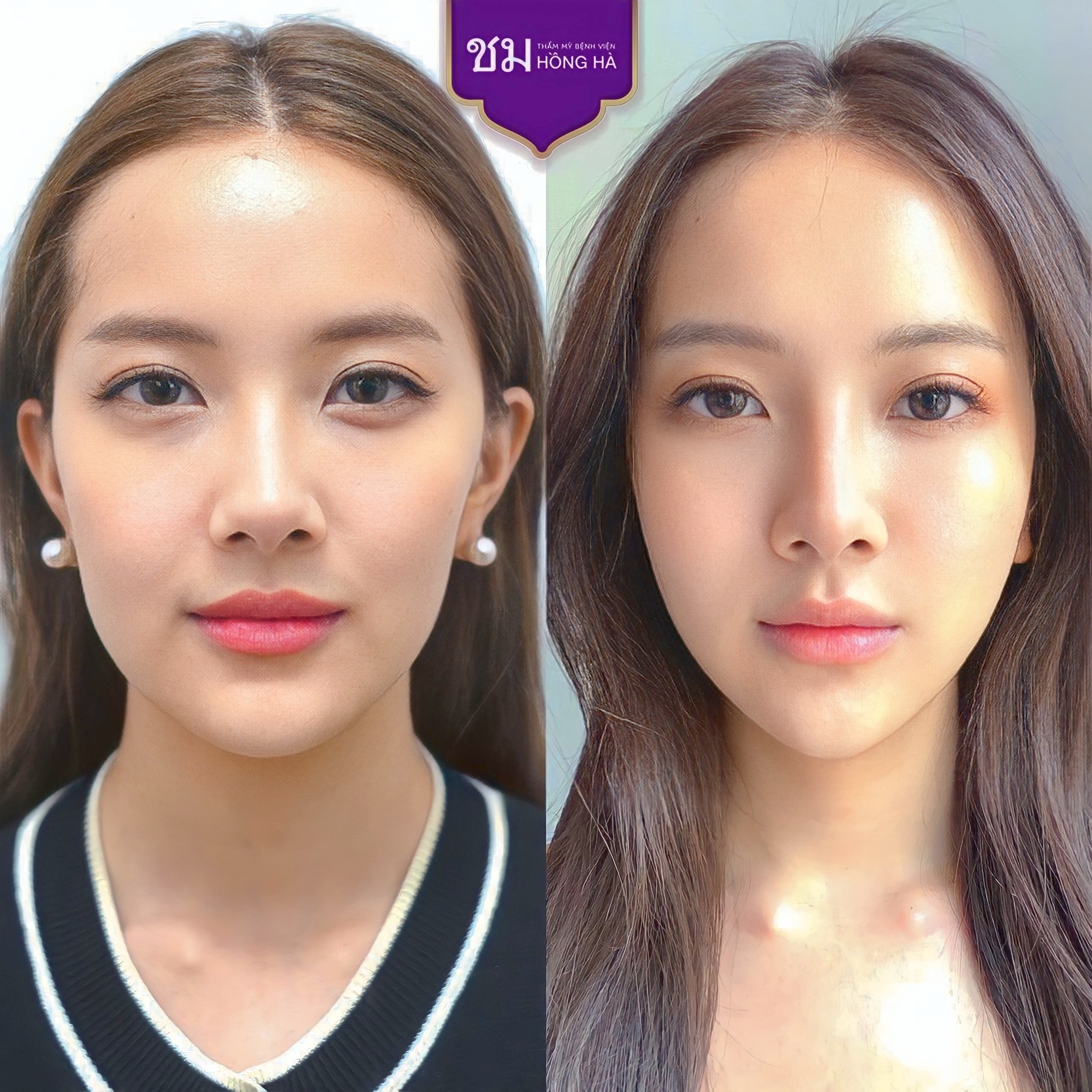 Công nghệ gọt hàm chuẩn Thái