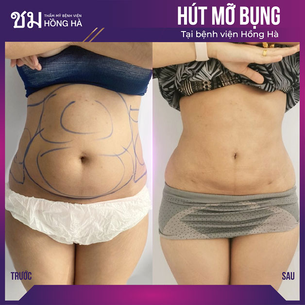 Kết quả sau hút mỡ của khách hàng Hà Thị Nga, thấy rõ sự thay đổi của vòng 2
